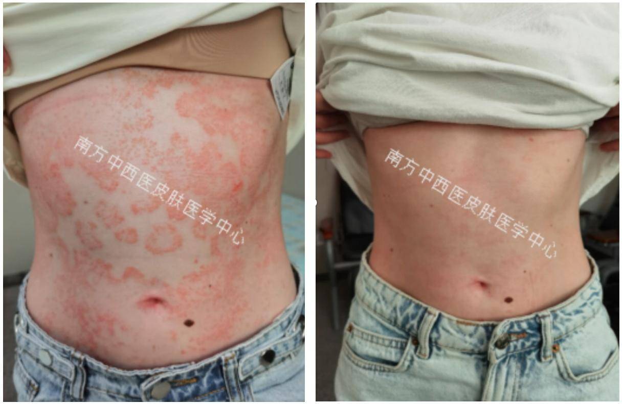 中医药再发威<strong></p>
<p>嗨币网</strong>，1个月让23岁美国姑娘走出“银”影