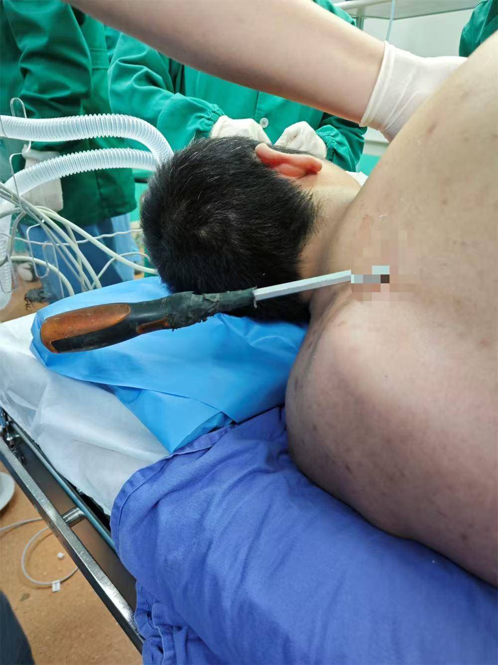 20米高空掉落螺丝刀直插男子胸腔<strong></p>
<p>上币保证金</strong>!医生:不要自行拔除