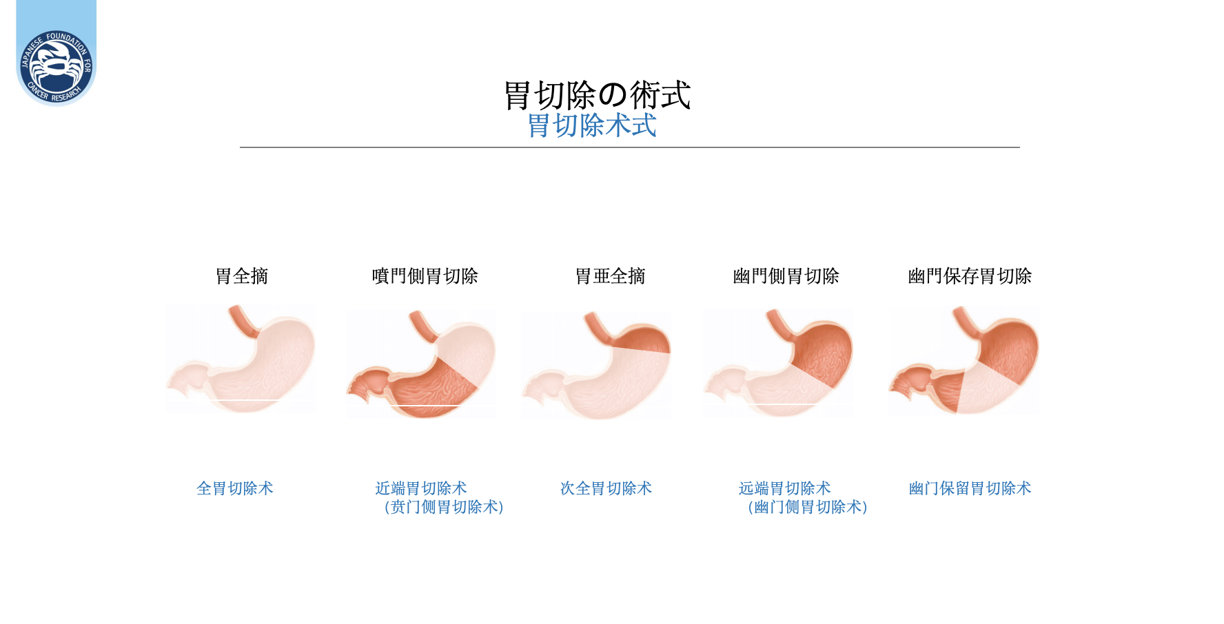 专访日本胃癌“神之手”:“全民除菌”是防癌关键第一步