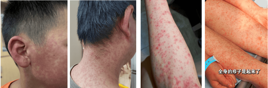 超6000例<strong></p>
<p>碰碰币</strong>!仍在新增!或发展成慢性病及有后遗症!上海华山医院:这些驱蚊产品没用!