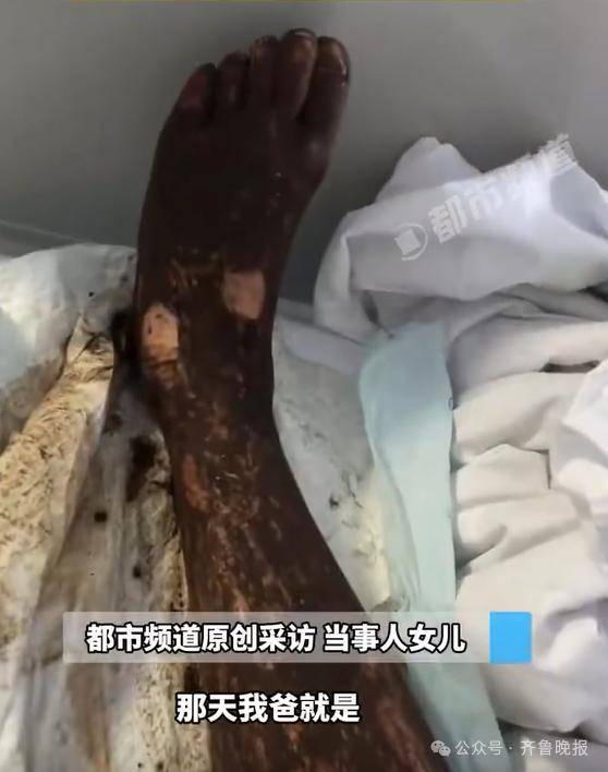 安徽宣城一男子走路玩手机<strong></p>
<p>同方股份股票</strong>,一脚踩中打架的竹叶青和五步蛇,被俩毒蛇咬3口!医院:暂无生命危险,正在治疗