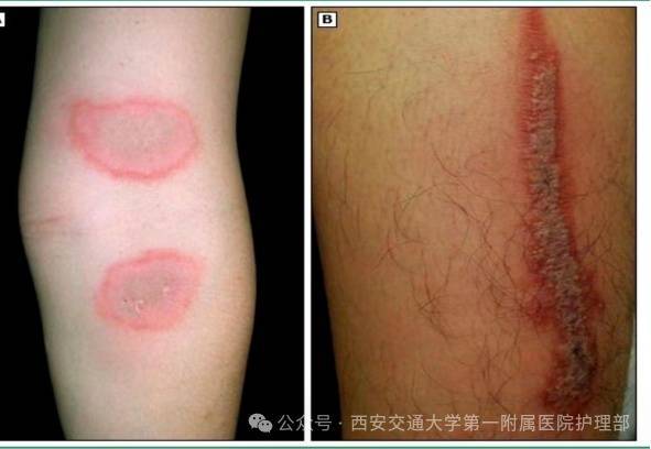 西安多区发现隐翅虫？千万别拍<strong></p>
<p>宝钢股份股票</strong>！毒液堪比硫酸