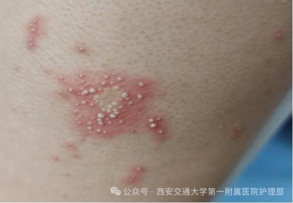 西安多区发现隐翅虫？千万别拍<strong></p>
<p>宝钢股份股票</strong>！毒液堪比硫酸