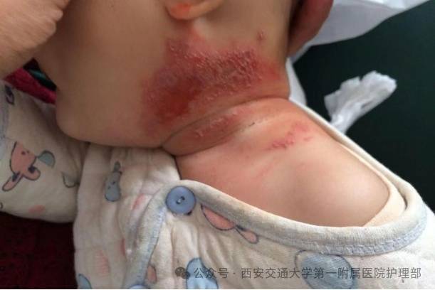 西安多区发现隐翅虫？千万别拍<strong></p>
<p>宝钢股份股票</strong>！毒液堪比硫酸